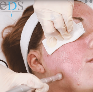 Clinical Treatments. skin needling