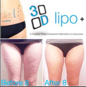 Treatments for the Body . 3D lipo