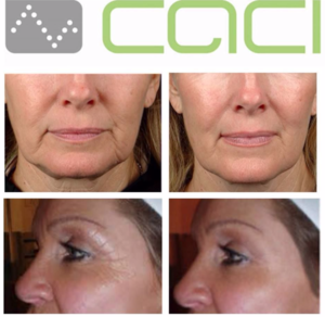 Treatments for the Face . CACI